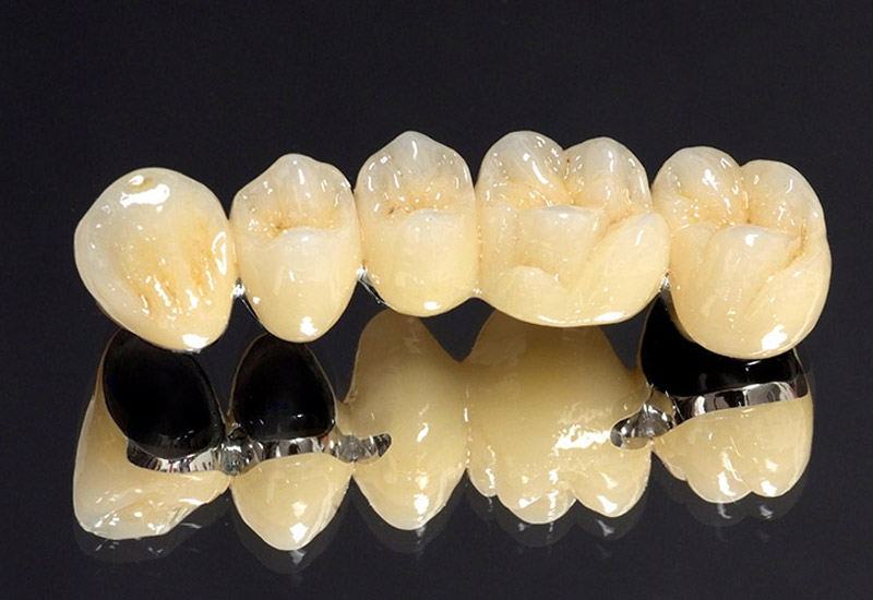 Hình ảnh răng sứ kim loại thường