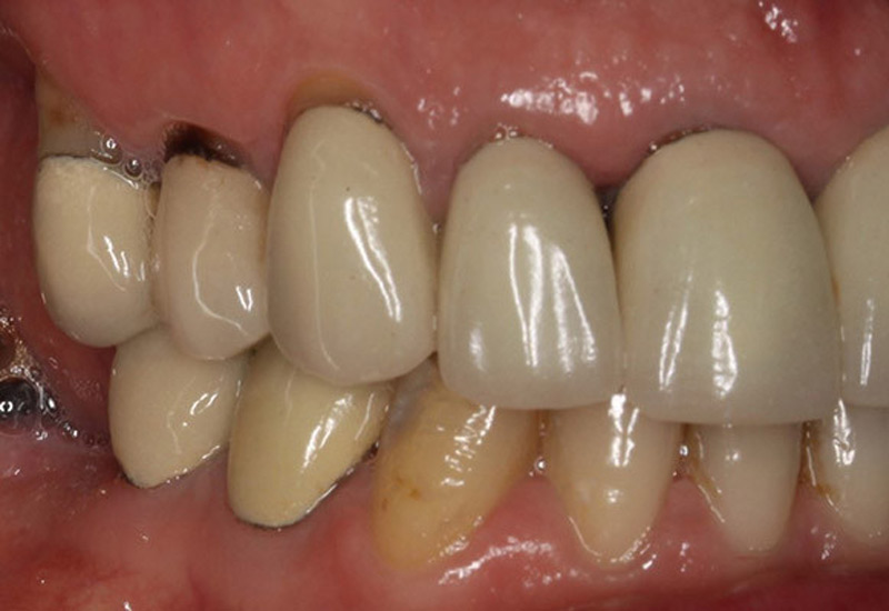 Bọc răng sứ kim loại thường có thể dẫn đến viền chân răng bị đen