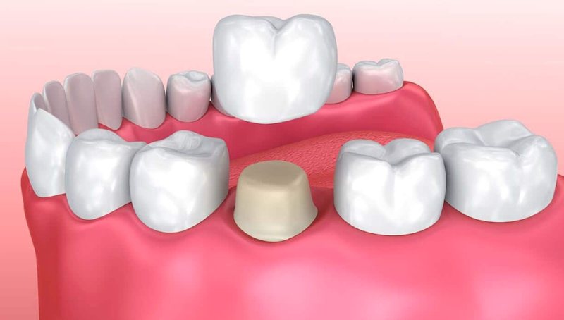 Quy trình bọc răng sứ cần đảm bảo tiêu chuẩn để đạt được kết quả tốt nhất