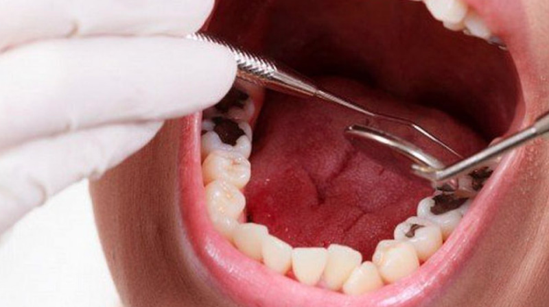 Trường hợp răng mắc các bệnh lý như sâu răng, viêm nướu,... cần phải điều trị trước khi bọc sứ