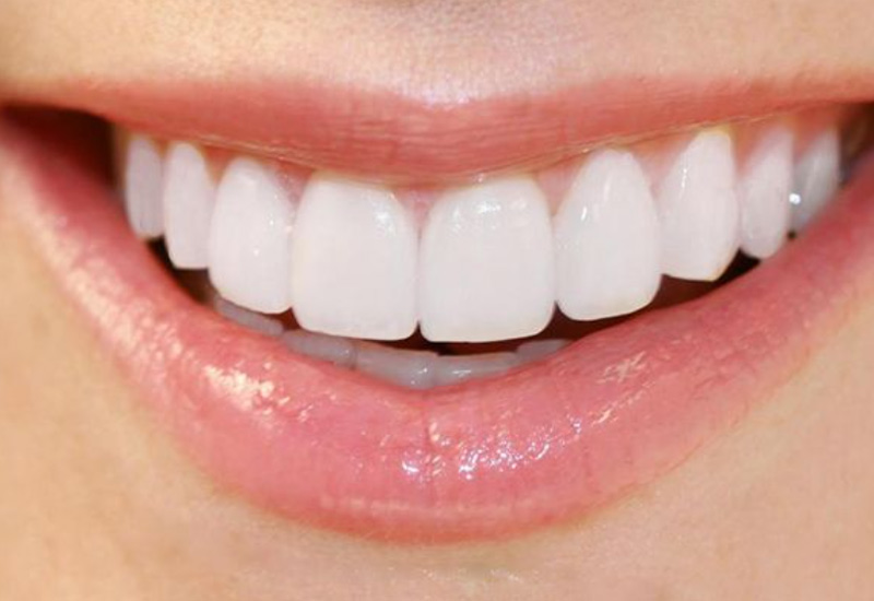 Số lượng răng cần bọc sứ sẽ ảnh hưởng đến chi phí bọc răng sứ nguyên hàm