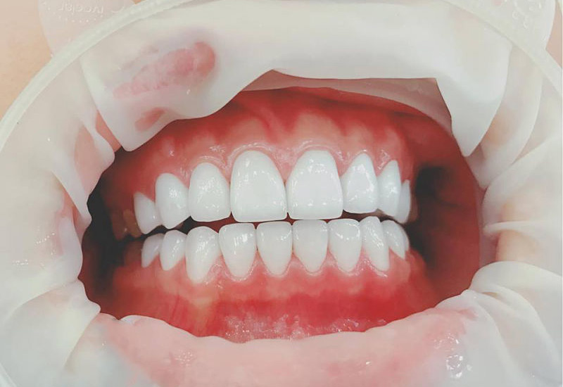 Bọc răng sứ là phương pháp thẩm mỹ nha khoa rất phổ biến