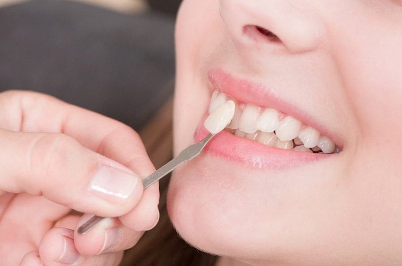 Giá dán răng sứ Veneer trung bình hiện đang dao động từ 6 đến 8 triệu đồng