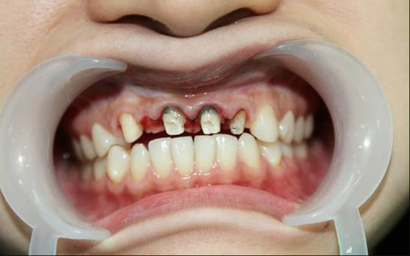 Tỷ lệ răng thật bị mài đi khi bọc sứ Zirconia khá nhiều nên có thể ảnh hưởng về lâu dài