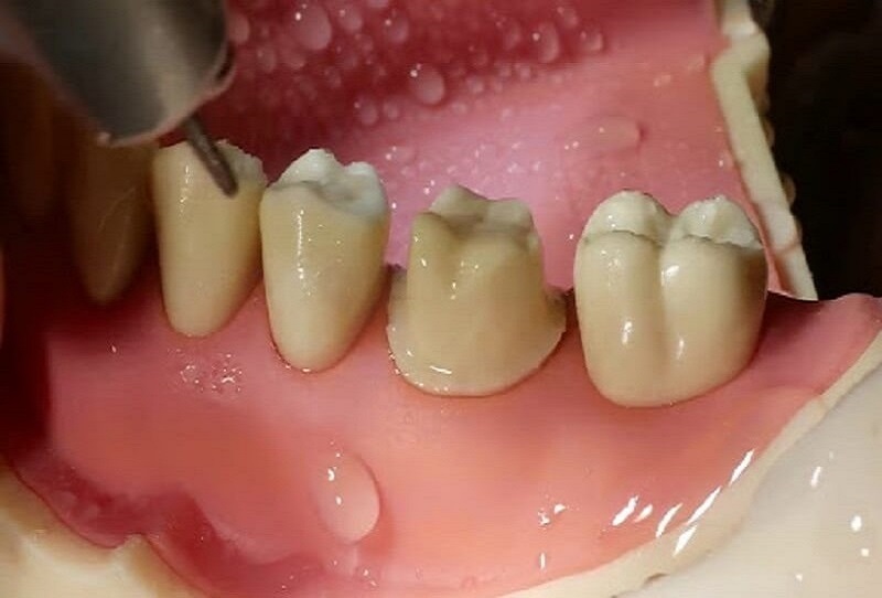 Mài cùi răng được chỉ định trong nha khoa thẩm mỹ