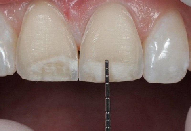 Nhiều người thường lo ngại việc mài răng sẽ gây đau đớn