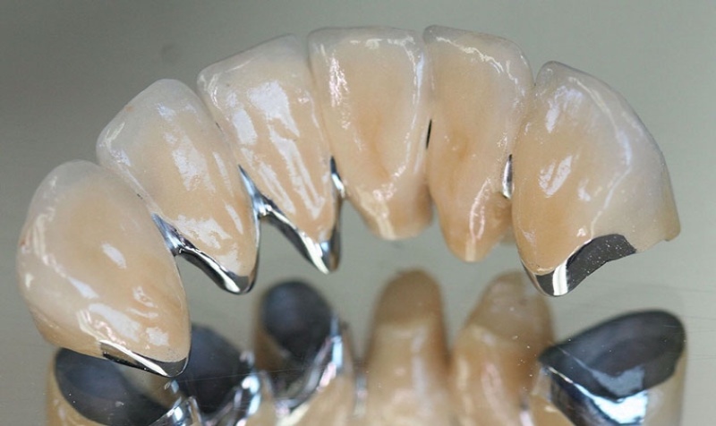 Mão sứ là một dạng răng giá có kích thước, màu sắc giống hệt răng thật