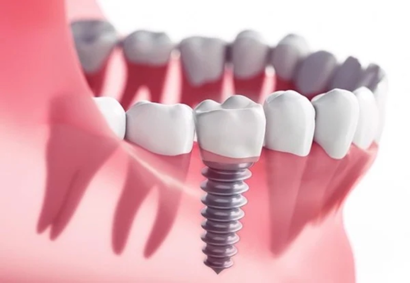 Implant là kỹ thuật trồng răng hiện đại nhất hiện nay