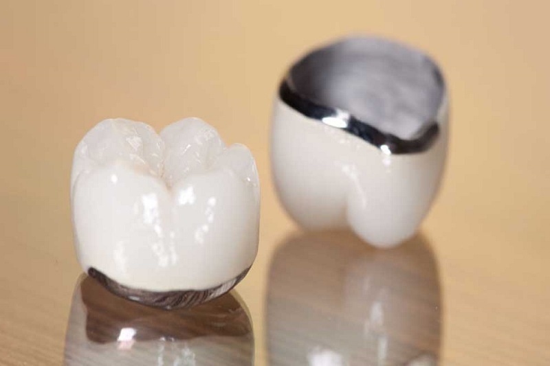 Răng sứ titan được làm bằng chất liệu Niken-Crom-Titan