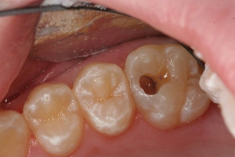 Sâu răng tiến triển gây phá huỷ men, làm hỏng răng hoàn toàn