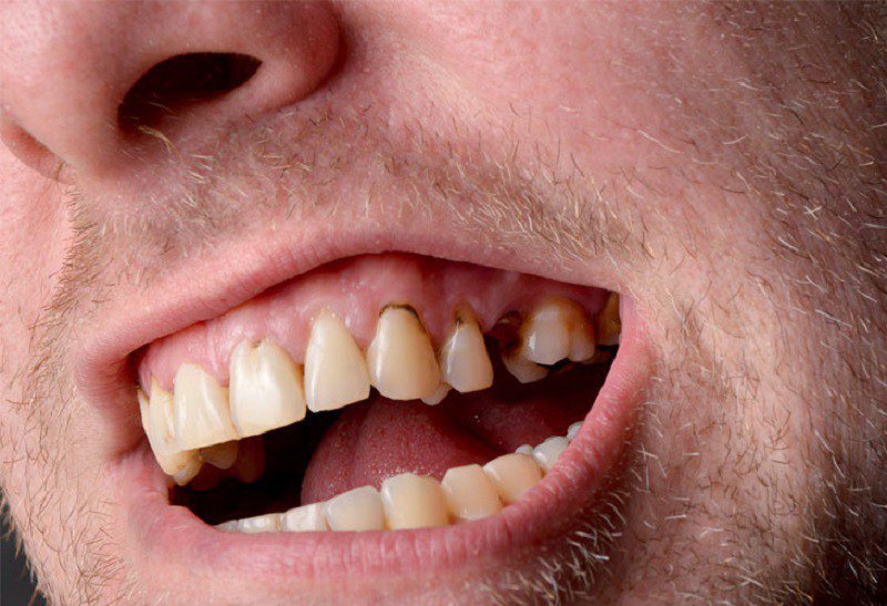 Dấu hiệu nhận biết thiếu sản men là bề mặt răng mềm mỏng, dễ lộ lớp ngà bên dưới.
