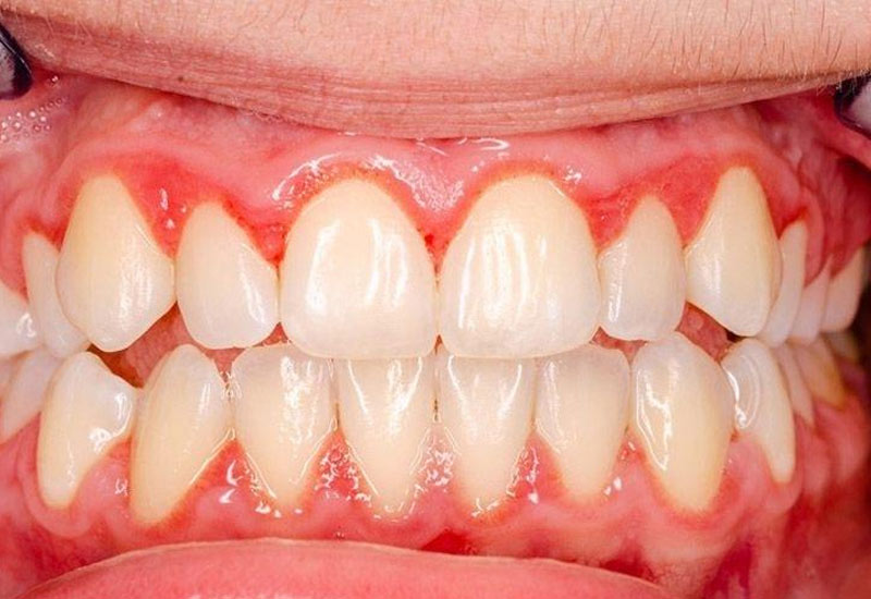 Nướu bị viêm là nguyên nhân phổ biến dẫn đến răng bọc sứ bị chảy máu