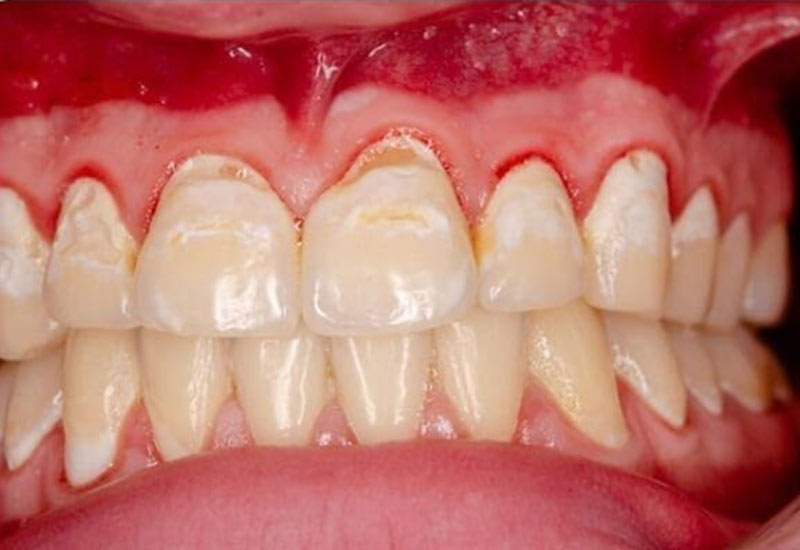 Quy trình làm răng sứ không đảm bảo cũng dẫn đến tình trạng chảy máu