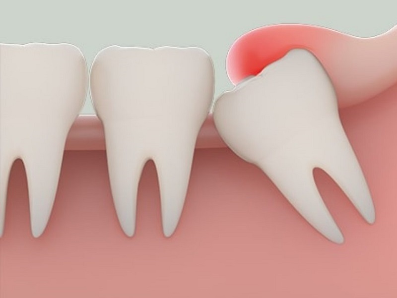 Nhổ răng xong cần tuân theo chỉ định của bác sĩ nha khoa