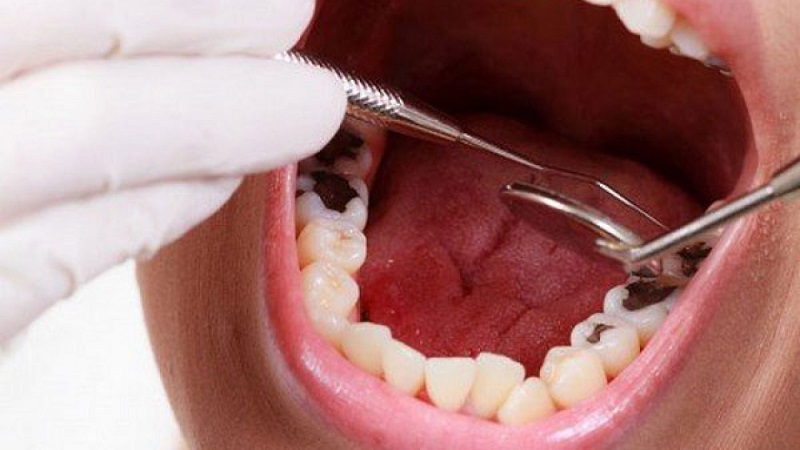 Biện pháp tốt nhất để khắc phục tình trạng này đó là nhổ răng