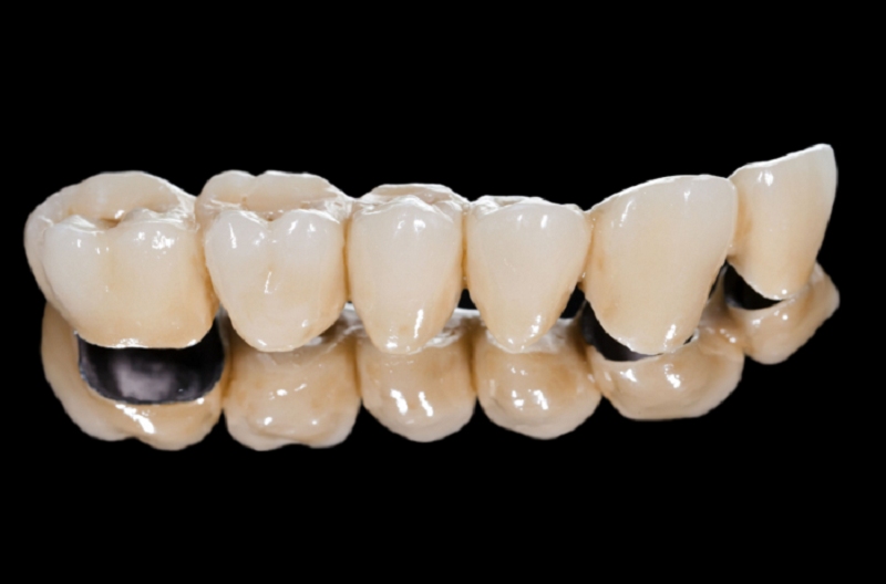 Loại răng này thường được sử dụng trong trường hợp bọc răng sứ