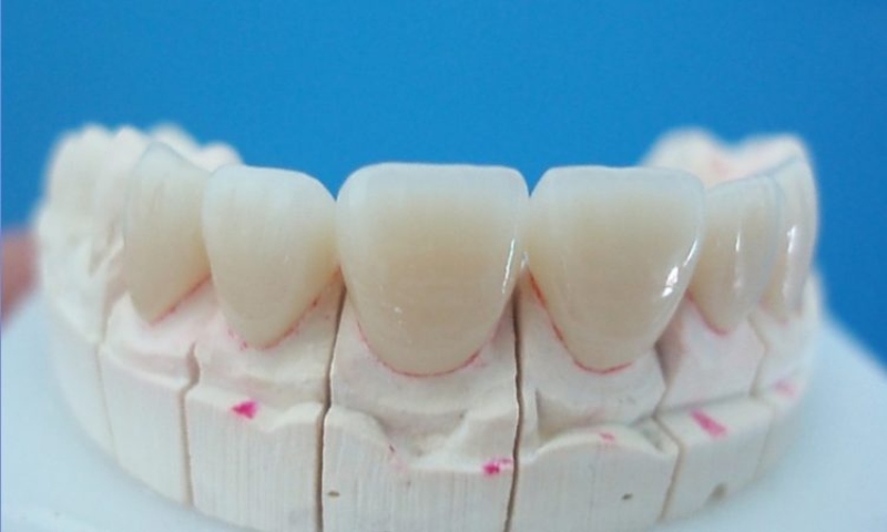 Răng sứ Ceramill có cấu tạo toàn sứ, không kim loại