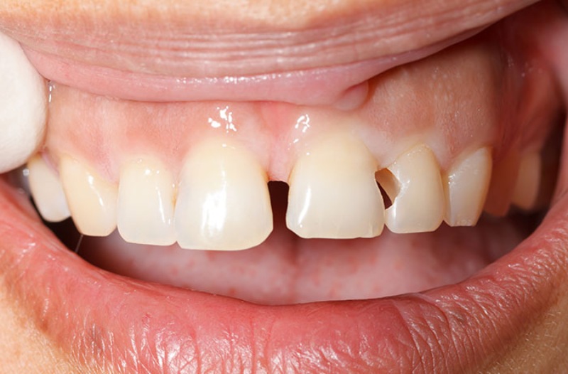 Bọc răng sứ trong trường hợp răng sứt mẻ, lệch lạc