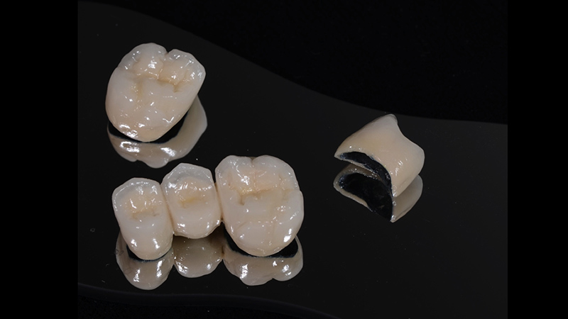 Răng sứ Titan là loại răng sứ được nhiều khách hàng lựa chọn 