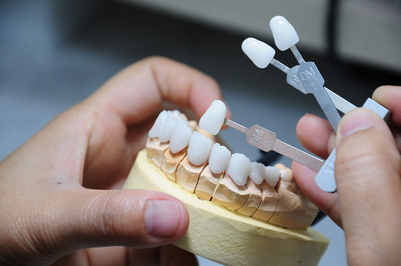 Chi phí bọc răng sứ Titan còn phụ thuộc vào số lượng răng cần phục hình