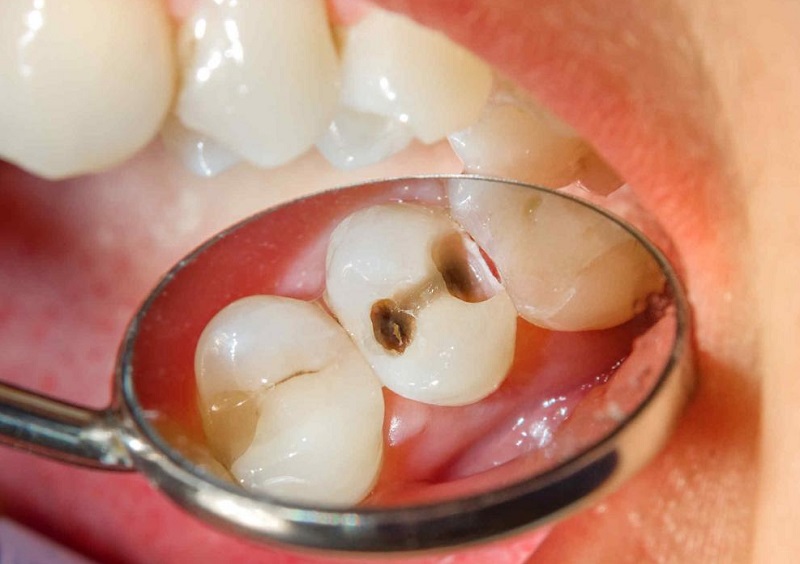 Tùy vào từng mức độ bệnh mà có nhiều cách điều trị răng sâu ăn vào tủy khác nhau