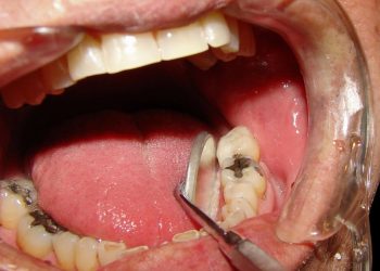 Sâu Răng Ăn Vào Tủy: Dấu Hiệu Nhận Biết Và Cách Điều Trị An Toàn