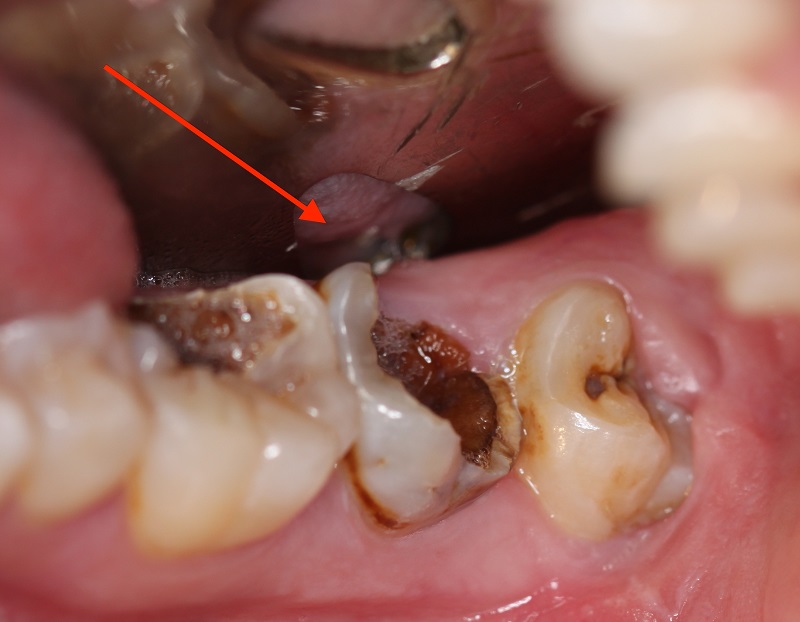 Sâu răng ở mức độ nặng khiến vi khuẩn ăn sâu vào tủy