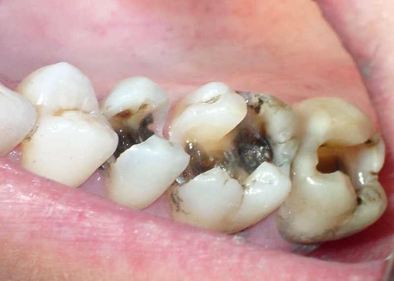 Sâu răng thường xuất hiện ở người lớn, thanh thiếu niên và trẻ nhỏ