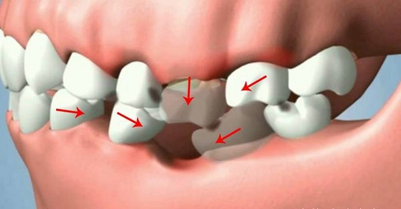 Nếu răng số 6 bị mất hoặc hỏng sẽ gây ảnh hưởng đến chức năng của hàm