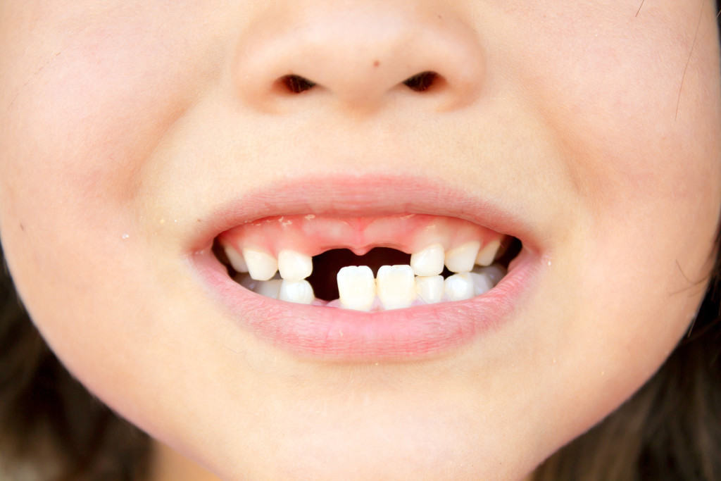 Sâu răng ở trẻ em có thể kéo dài trong vòng nhiều năm, lan từ răng này sang răng khác