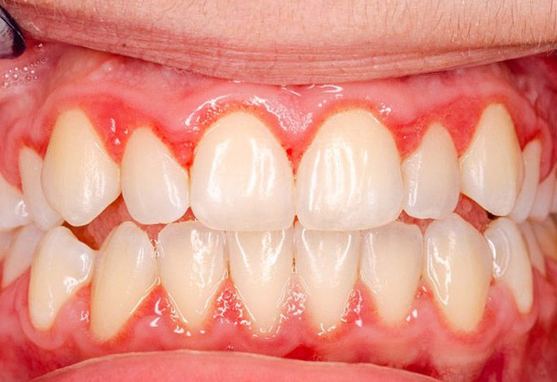 Viêm nướu là nguyên nhân phổ biến nhất dẫn đến chảy máu chân răng