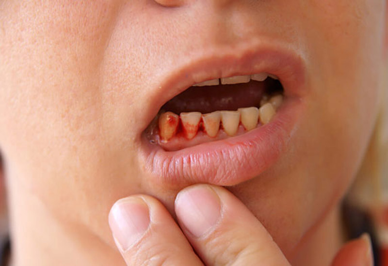 Sưng lợi chảy chảy máu chân răng là tình trạng vùng lợi xung quanh chân răng bị chảy máu.