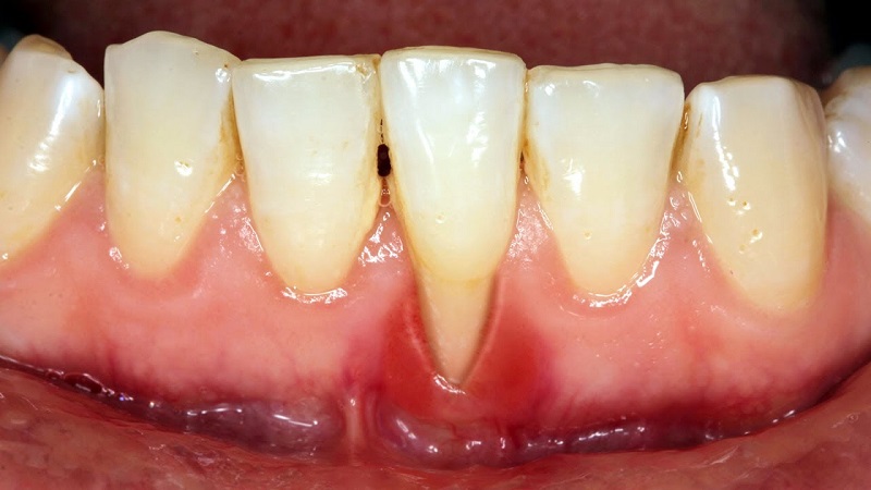Viêm lợi tụt lợi là bệnh lý nha khoa thường gặp khi vệ sinh răng miệng không đúng cách