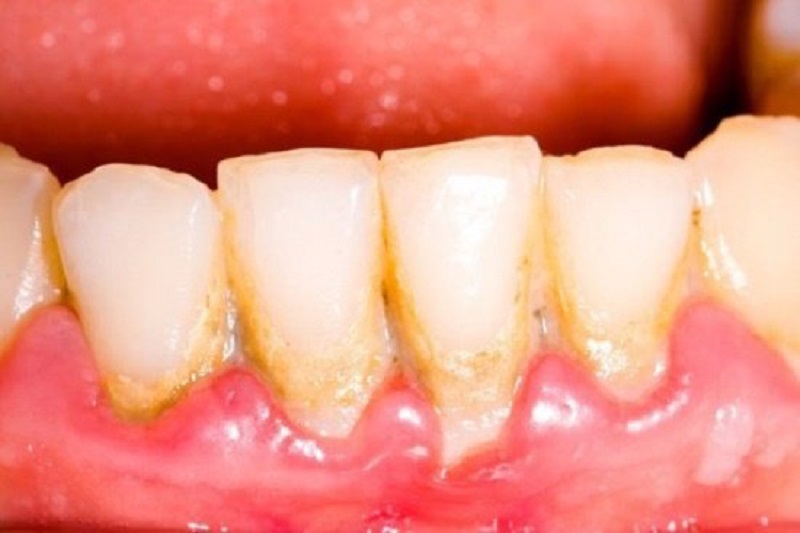 Cao răng là một trong những nguyên nhân tiêu biểu gây tụt lợi
