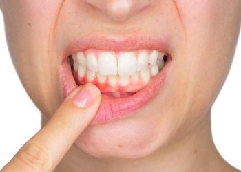 Viêm lợi tụt lợi hay còn được gọi là tụt nướu, là tình trạng nướu bị rút về phía dưới chân răng