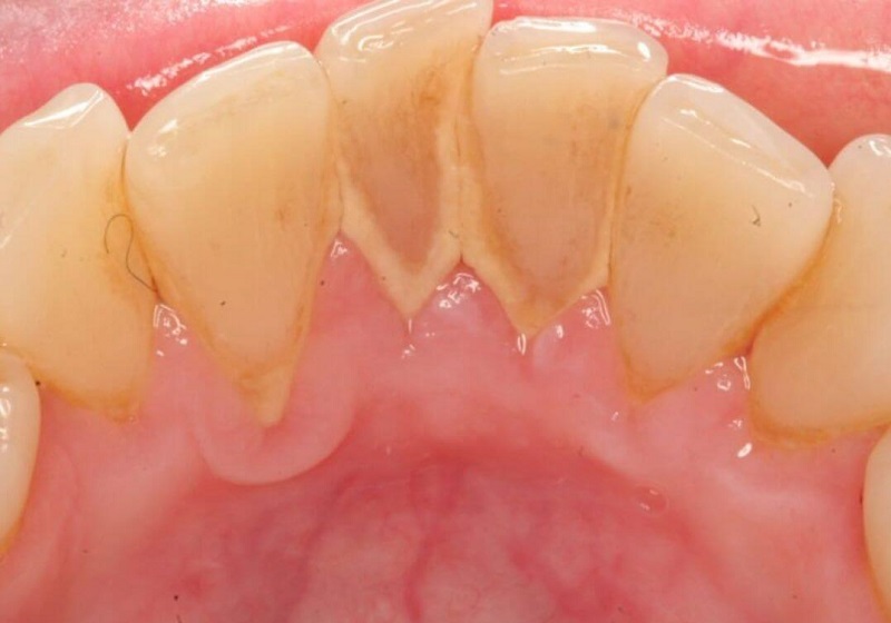 Nguyên nhân chủ yếu gây ra bệnh là do vệ sinh răng miệng không sạch sẽ