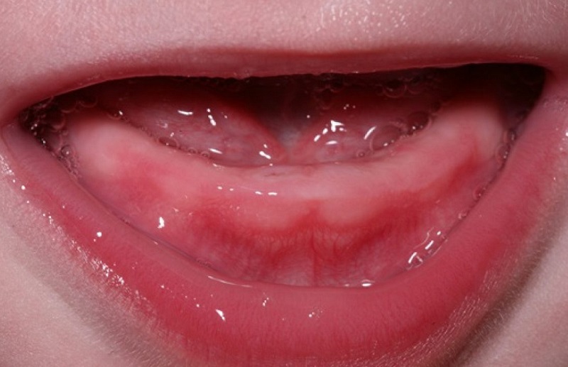 Trẻ bị viêm nướu răng có nhiều nguyên nhân khác nhau
