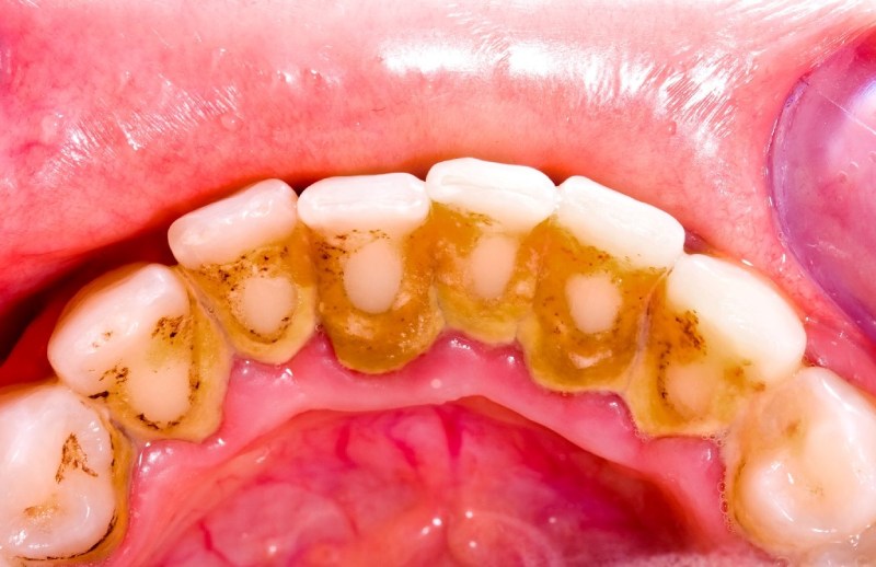 Mảng bám tích tụ ở viền chân răng lâu dài sẽ khiến chân răng bị đen
