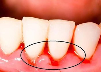 Tình trạng này gây nên nhiều vấn đề nghiêm trọng cho sức khỏe, thậm chí có thể gây rụng răng
