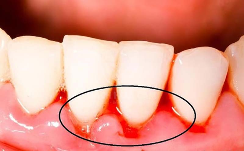 Tình trạng này gây nên nhiều vấn đề nghiêm trọng cho sức khỏe, thậm chí có thể gây rụng răng