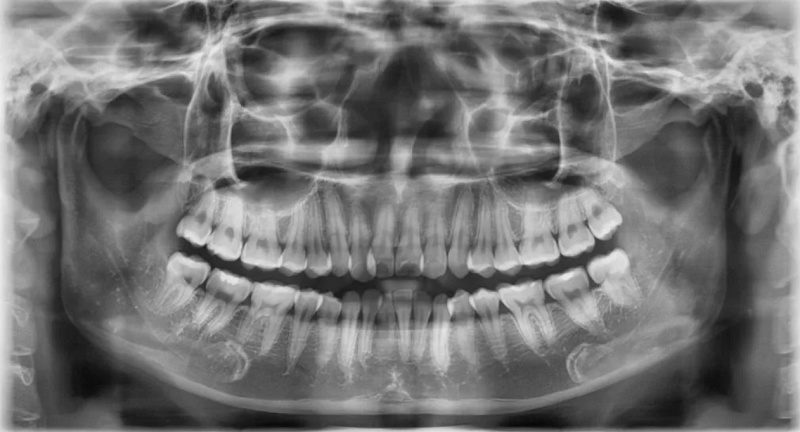 Chụp X quang răng là kỹ thuật giúp ghi lại rõ hình ảnh trong khoang miệng