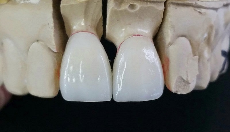 Răng sứ Emax là dòng răng toàn sứ nổi tiếng của Đức
