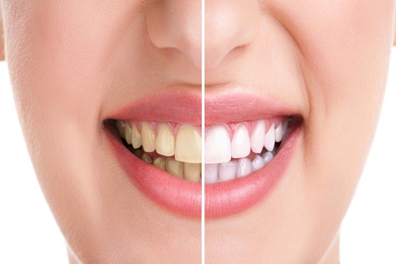Tình trạng răng xỉn màu sẽ được cải thiện nhanh chóng sau bọc răng sứ