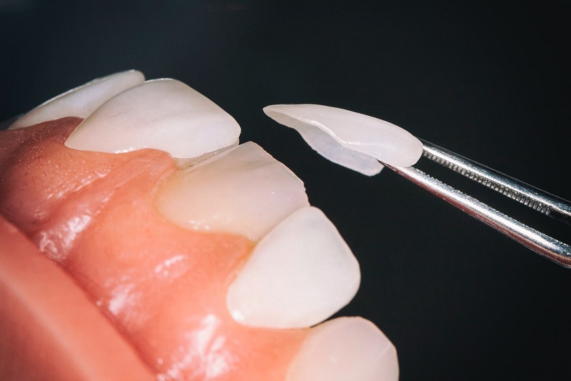 Dán sứ được chỉ định trong một số trường hợp răng bị nhiễm màu