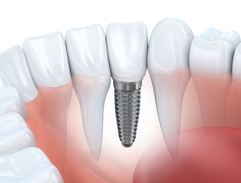 Gắn răng tạm được thực hiện trong khi chờ đợi implant lành thương hoàn toàn
