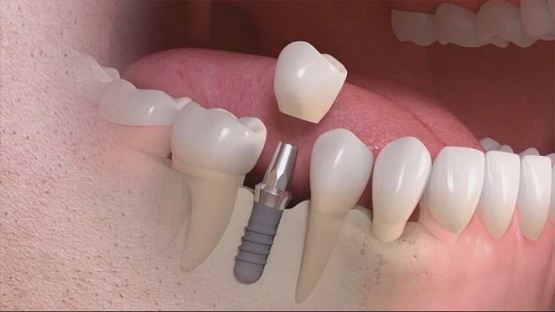 Răng tạm cố định được thực hiện phổ biến