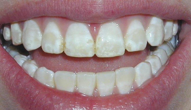 Men răng có thể bị hỏng do nhiều nguyên nhân khác nhau