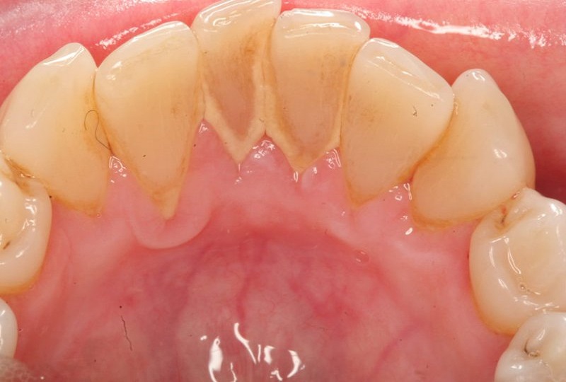 Kiểm tra sức khỏe răng miệng sẽ giúp loại bỏ cao răng kịp thời