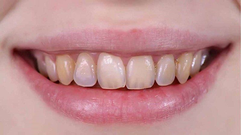 Răng ngả vàng là một trong những dấu hiệu của mòn men răng