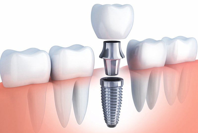 Trồng răng Implant là kỹ thuật phục hình răng hiện đại nhưng vẫn tồn tại một số nhược điểm